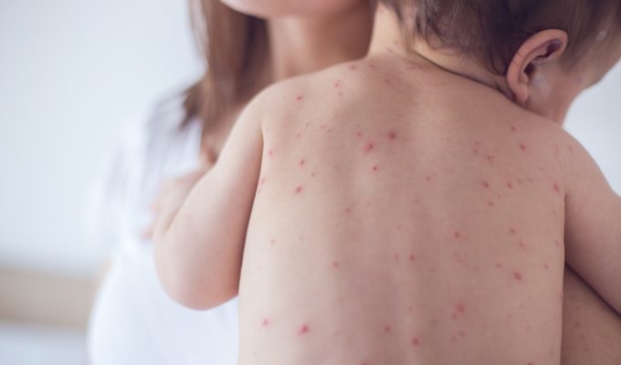 3 things you need to know about measles maternity and infant family
